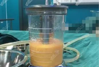 永城360度水动力吸脂费用多少钱？