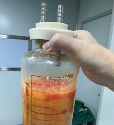 永城水动力吸脂手术要做多久？